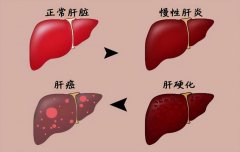 2024年《肝硬化中医诊疗指南》推荐强肝胶囊的应用
