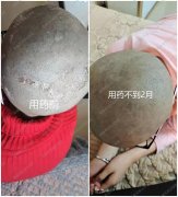 张梅英主任：儿童患牛皮